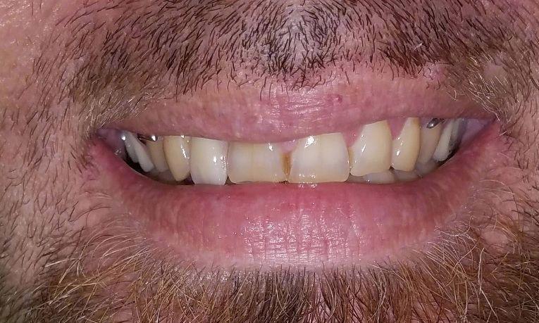 Smile after tooth replacement of upper tooth