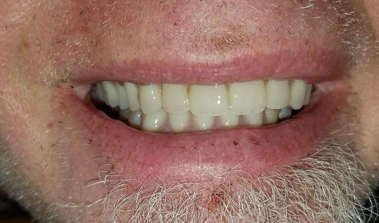 After tooth replacement 