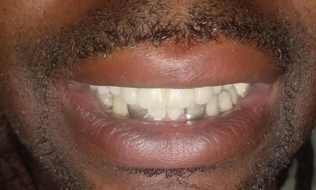 Before Same Day Denture | Dr. Russell Schafer