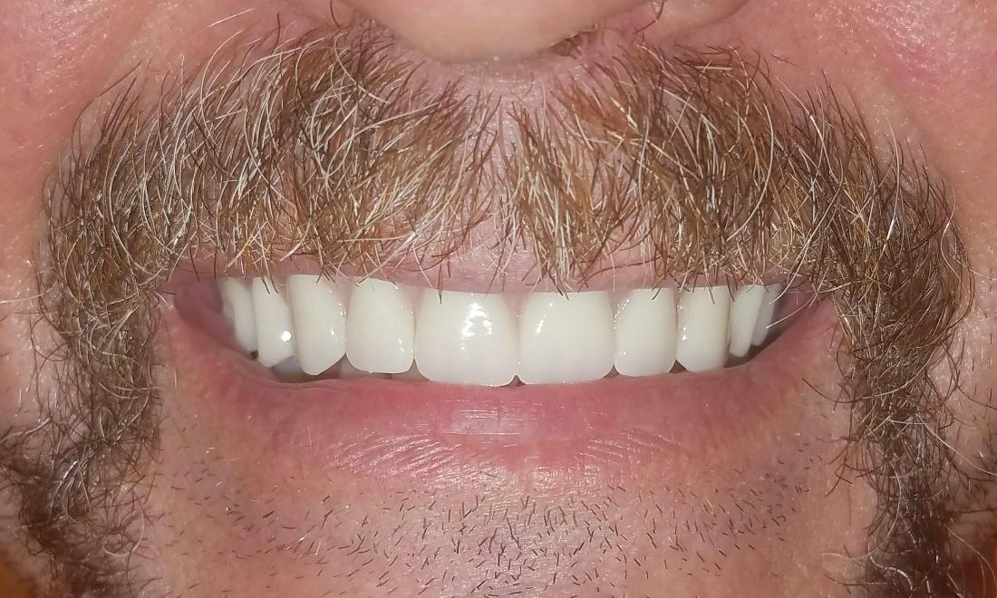 after photo of dentures