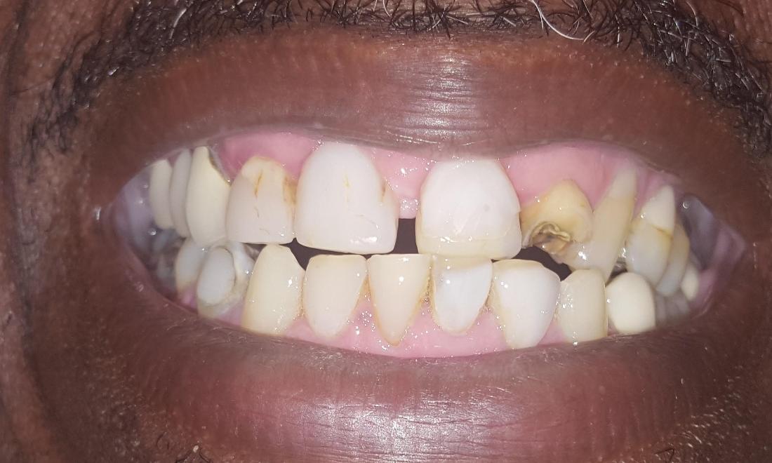 Before Denture Repair