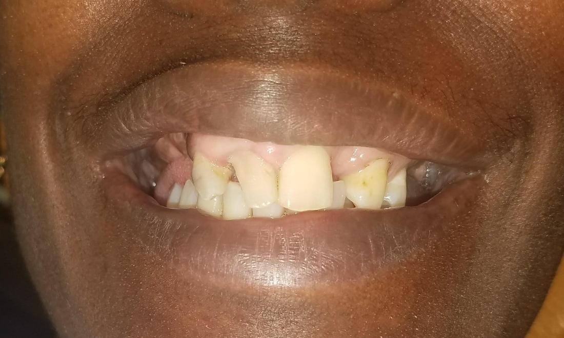 before image or damaged crooked teeth