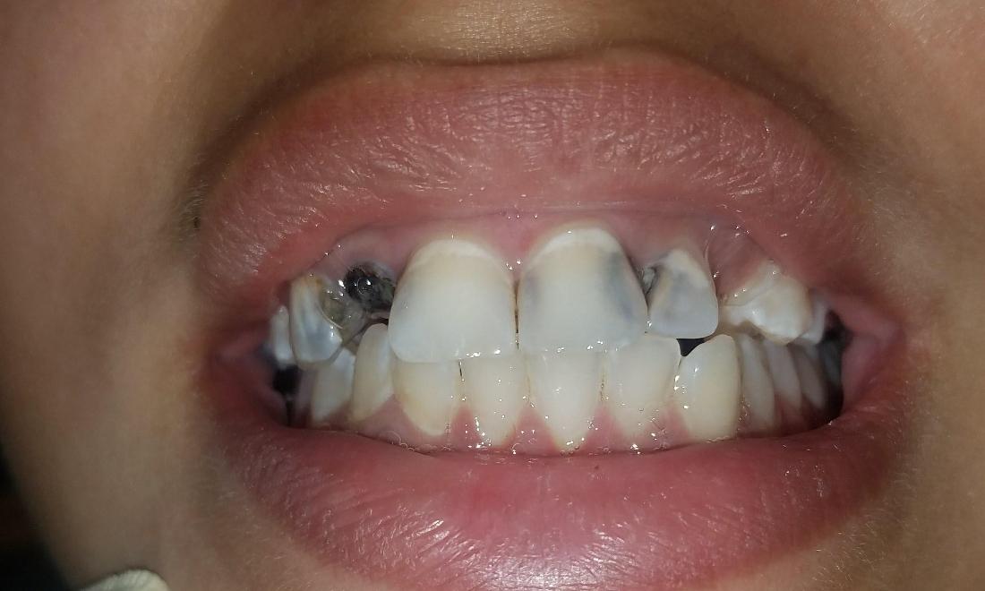 Patient with cavities in front | New Orleans LA