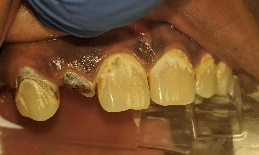 Bad Cavities | New Orleans Dentist