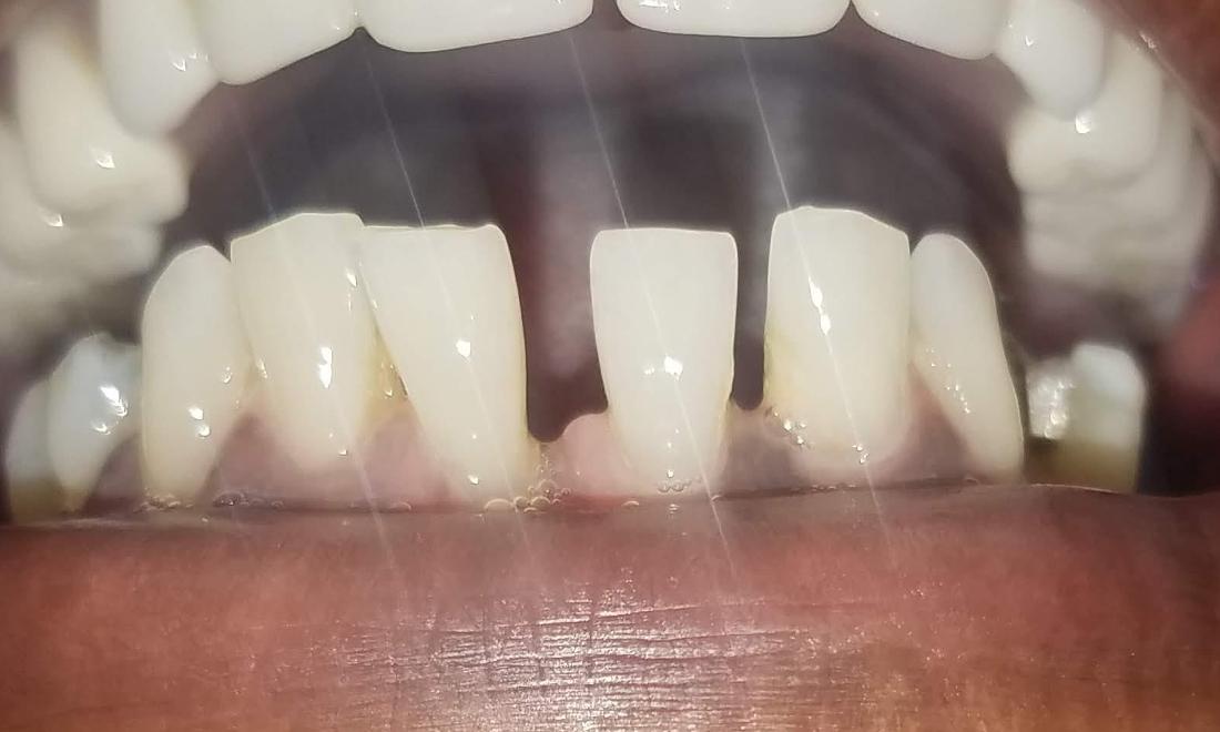 Patient Before Fixing Gaps | Gretna Dentist