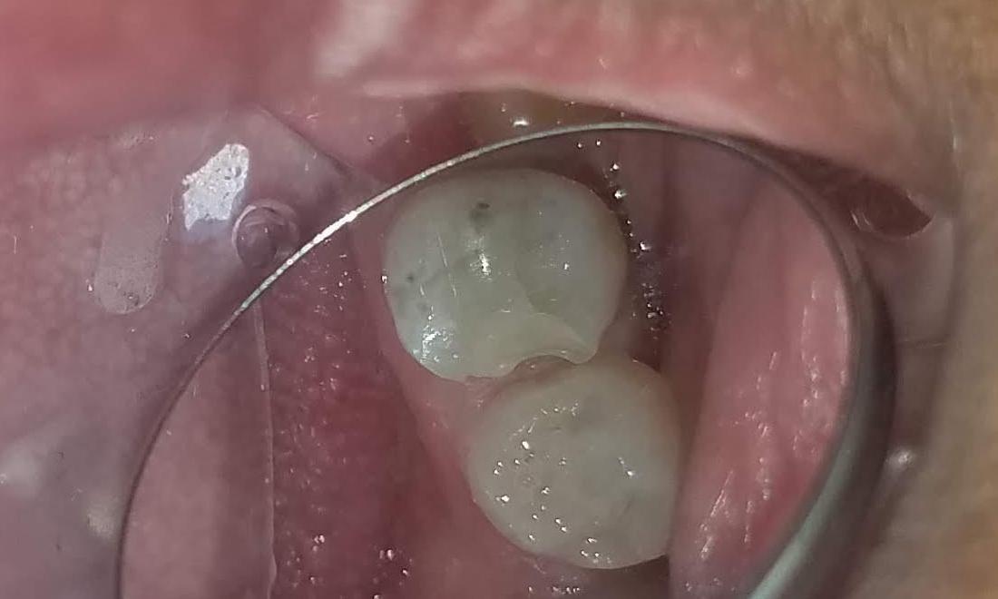Broken Tooth | NOLA Dentures & General Dentistry