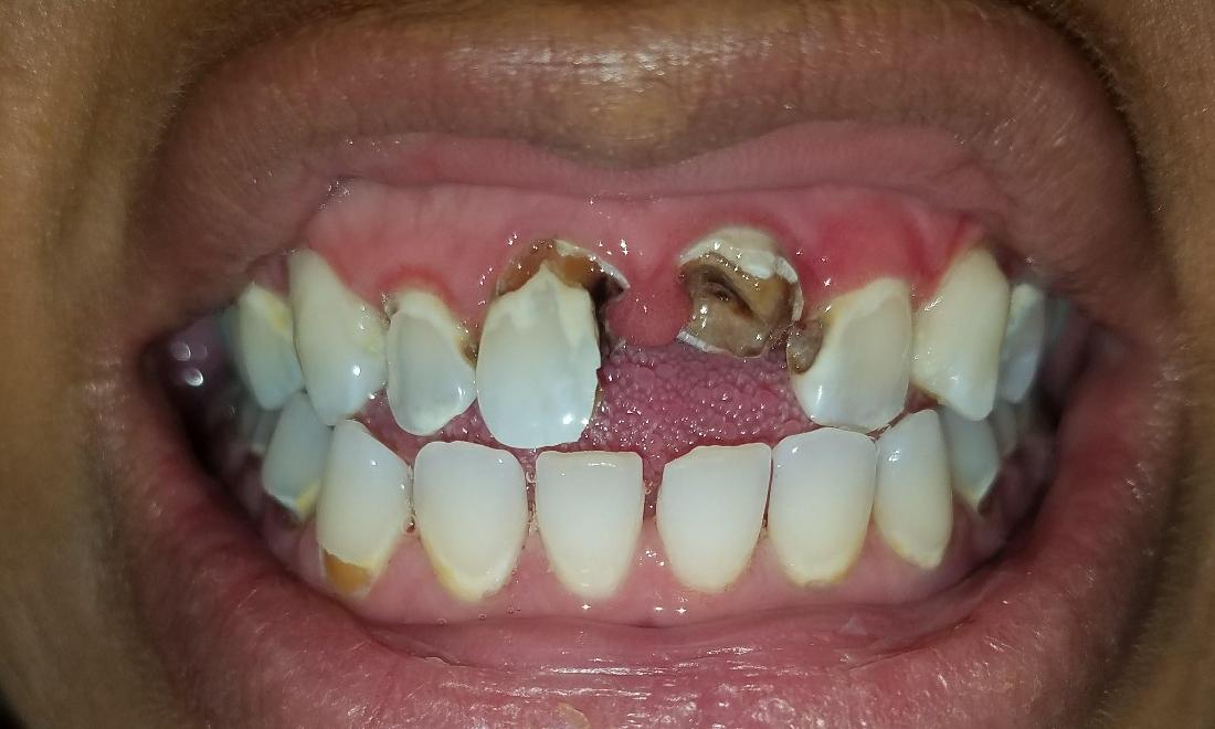 before image of rotten front teeth