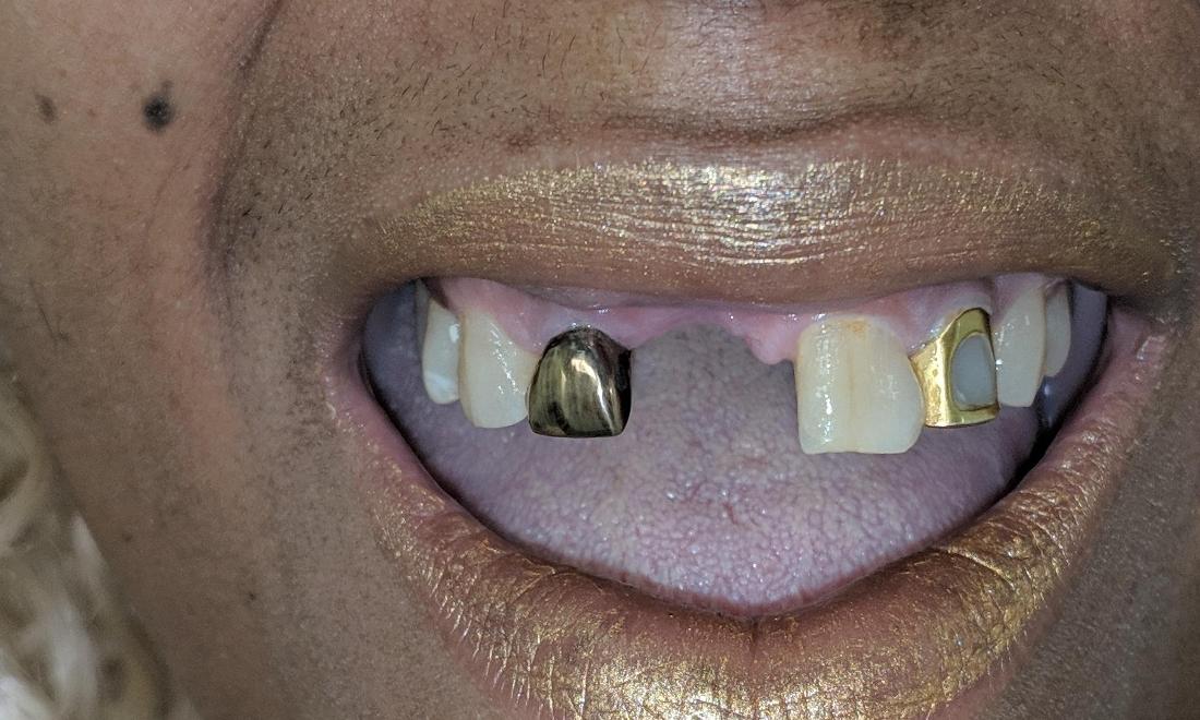 Missing Front Tooth | New Orleans LA