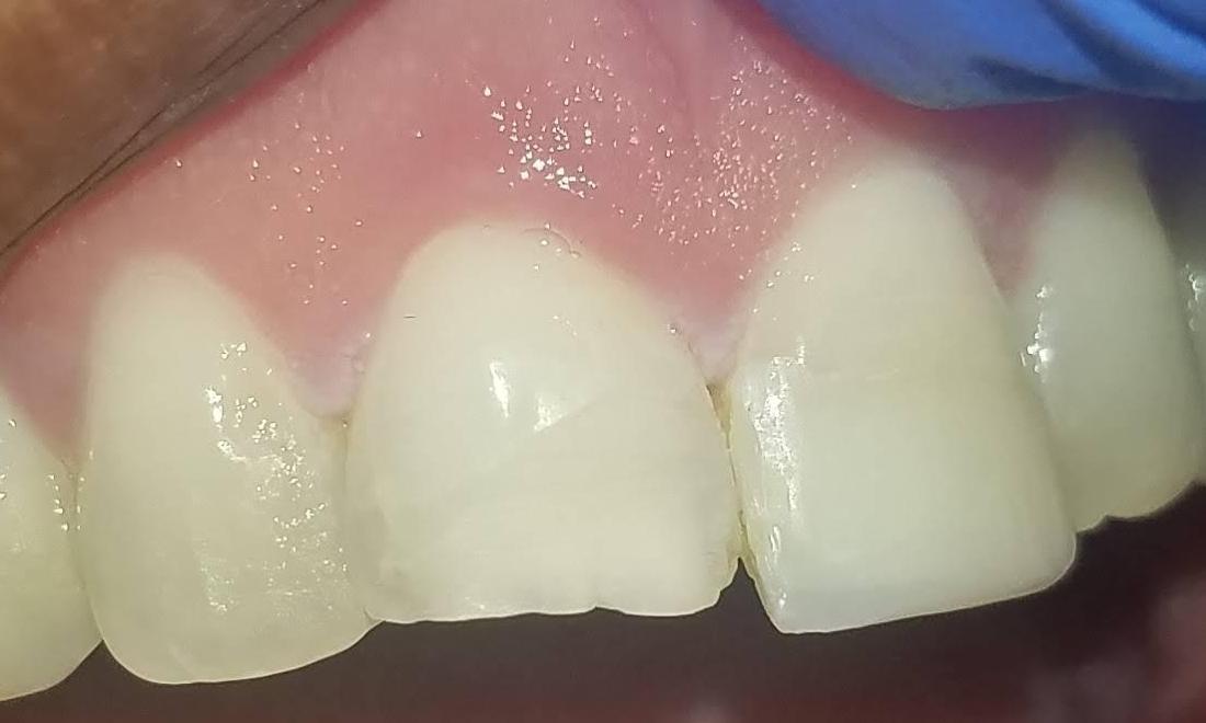 Front Chip in Tooth | Gretna Dentist