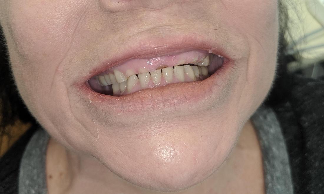 Broken front teeth smile