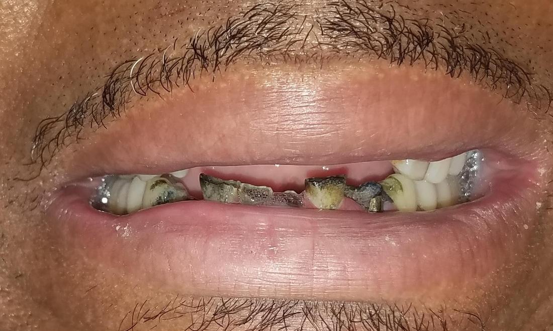 Missing Front Teeth Gretna LA