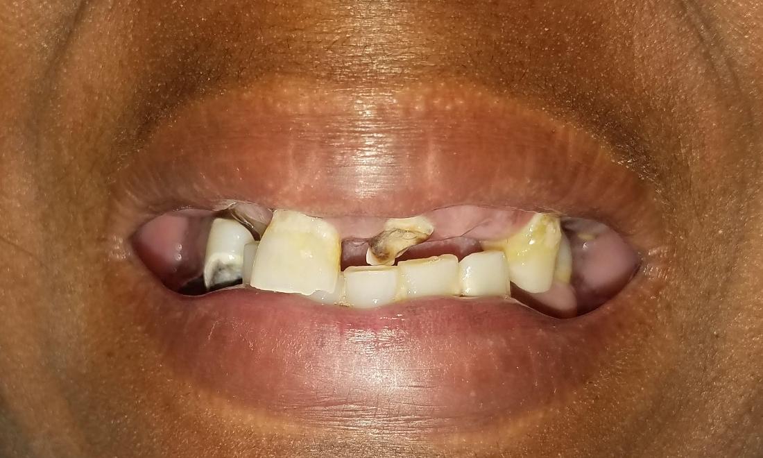 Before One Day Dentures | Dr. Schafer