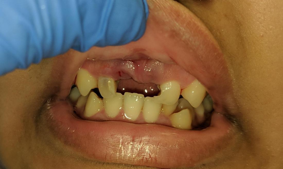 Broken Front Teeth | NOLA Dentist