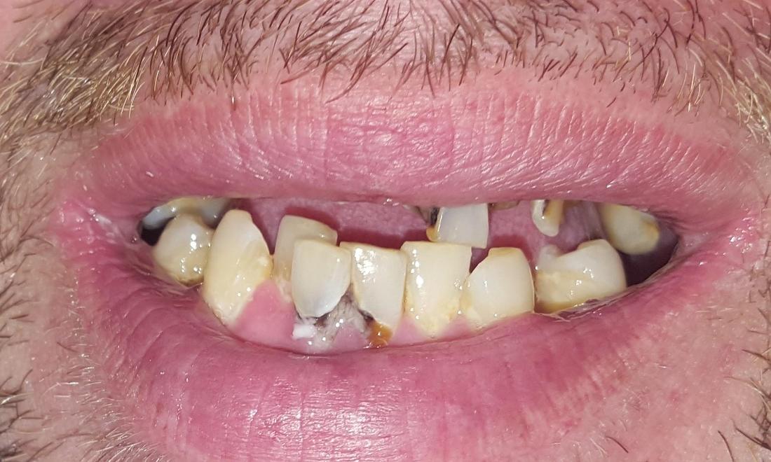 Before Dental Makeover | Dentist Gretna LA