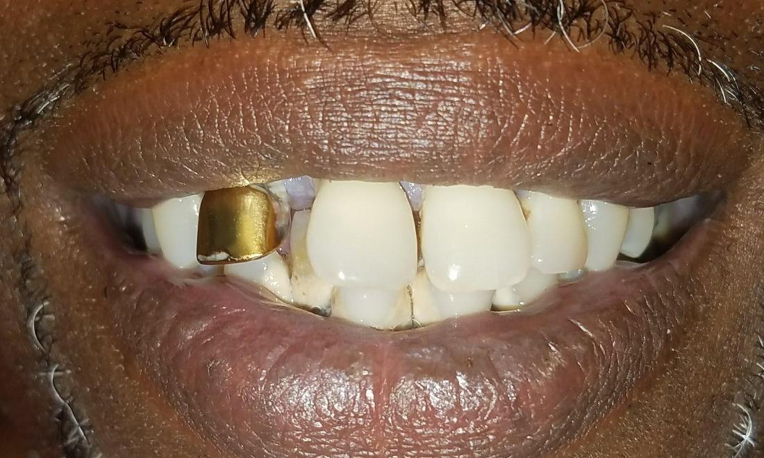 Gold Partial Dentures Smile Gallery Gretna LA