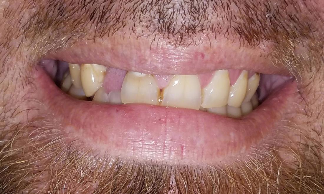 Before Full Dentures