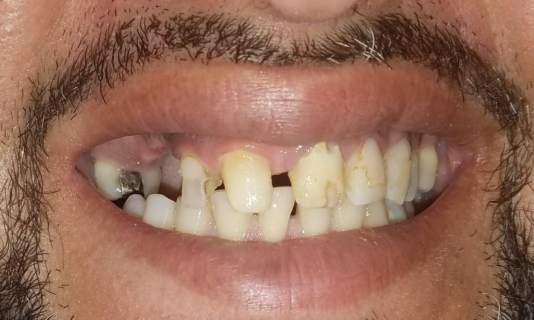 before image of decayed teeth