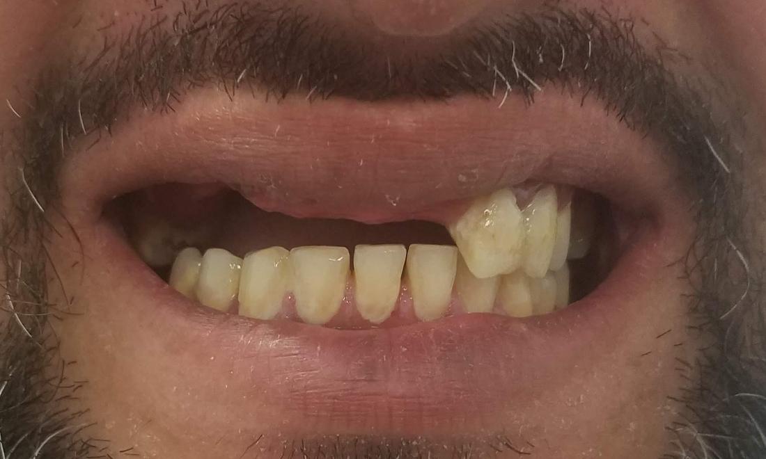 Broken Partial Denture | Gretna LA Dentist