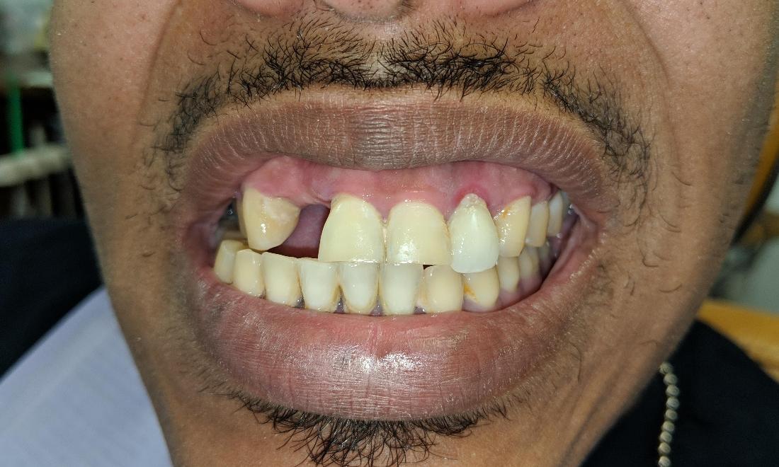 Missing Front Tooth | Dr. Russell Schafer