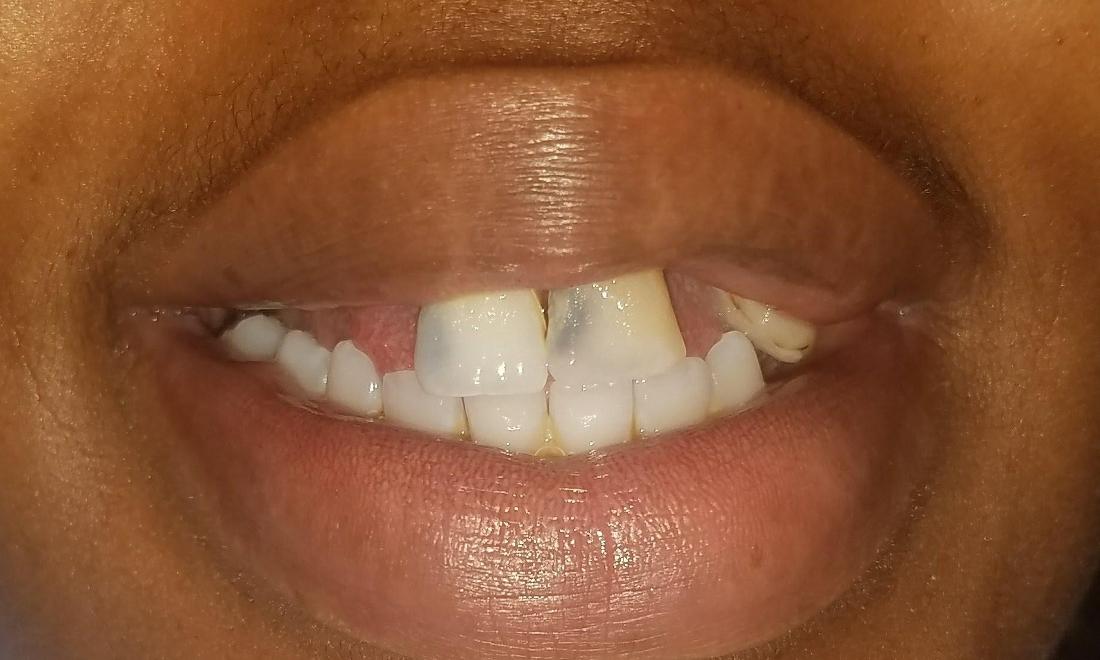 before photo of missing teeth