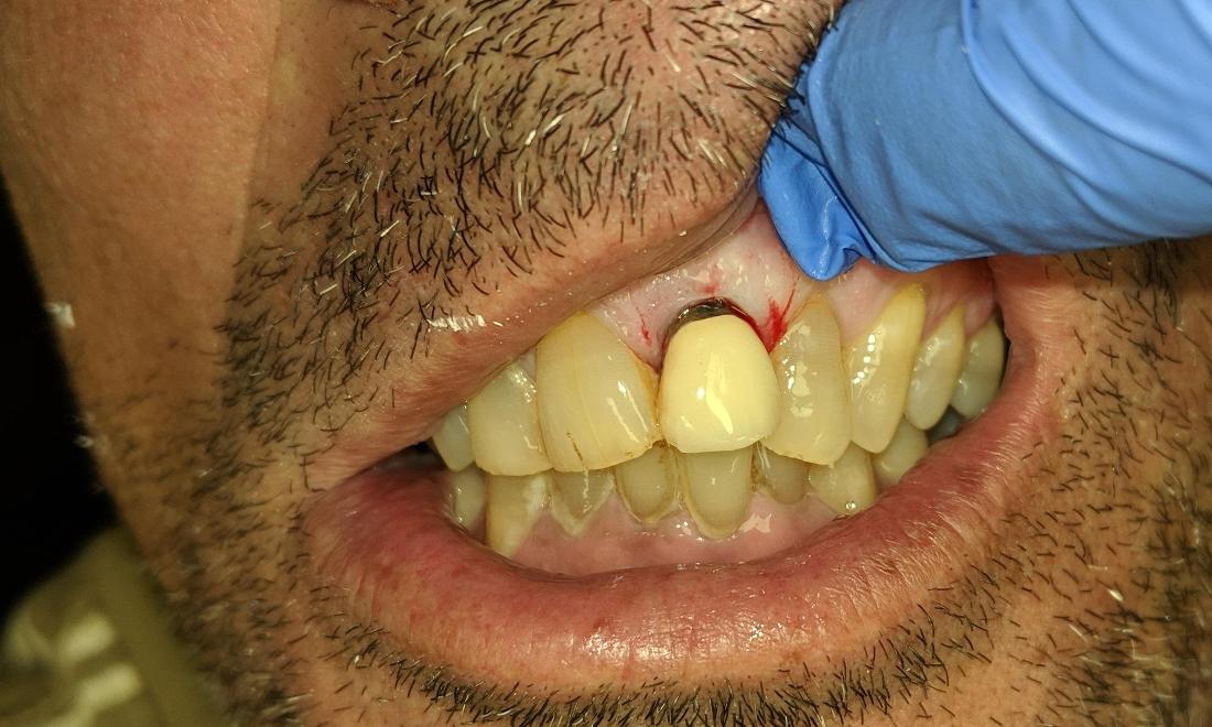 Bad Front Tooth | NOLA Dentist