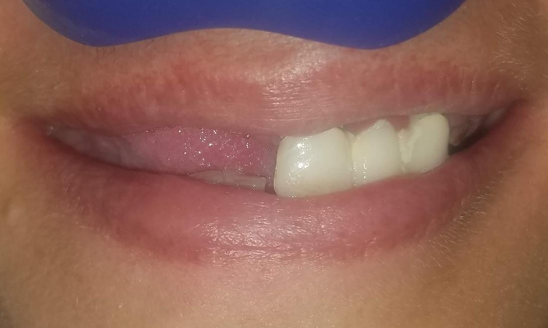 Missing Teeth Gretna LA 