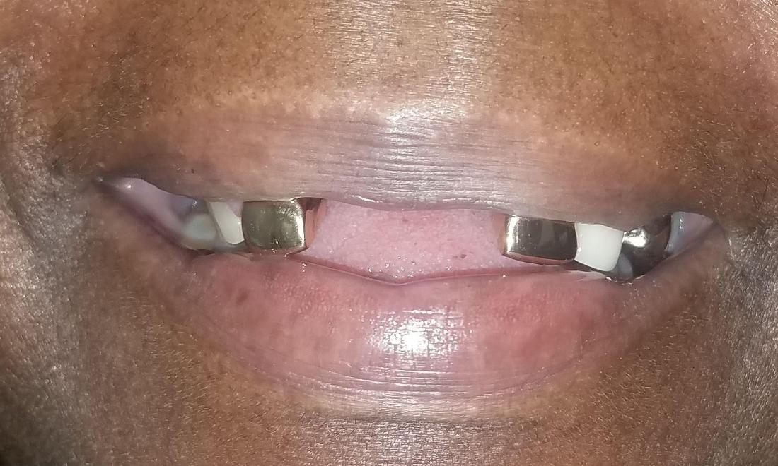 Missing Front Teeth in New Orleans