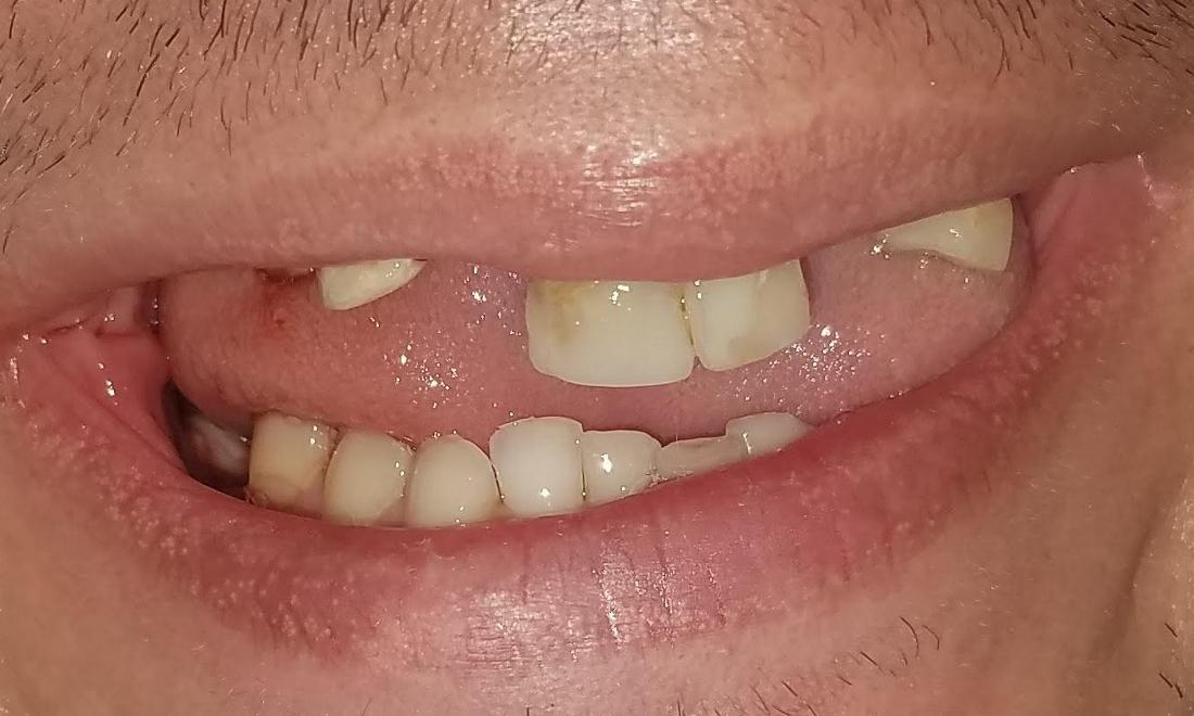 Missing Teeth | NOLA Dentist