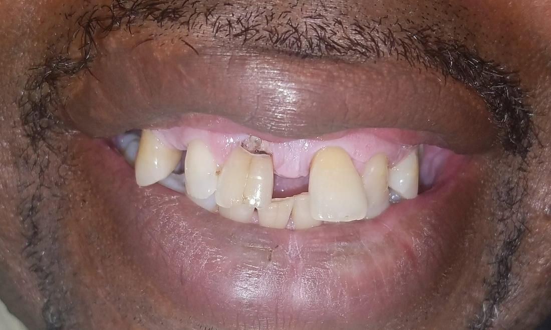 before smile makeover