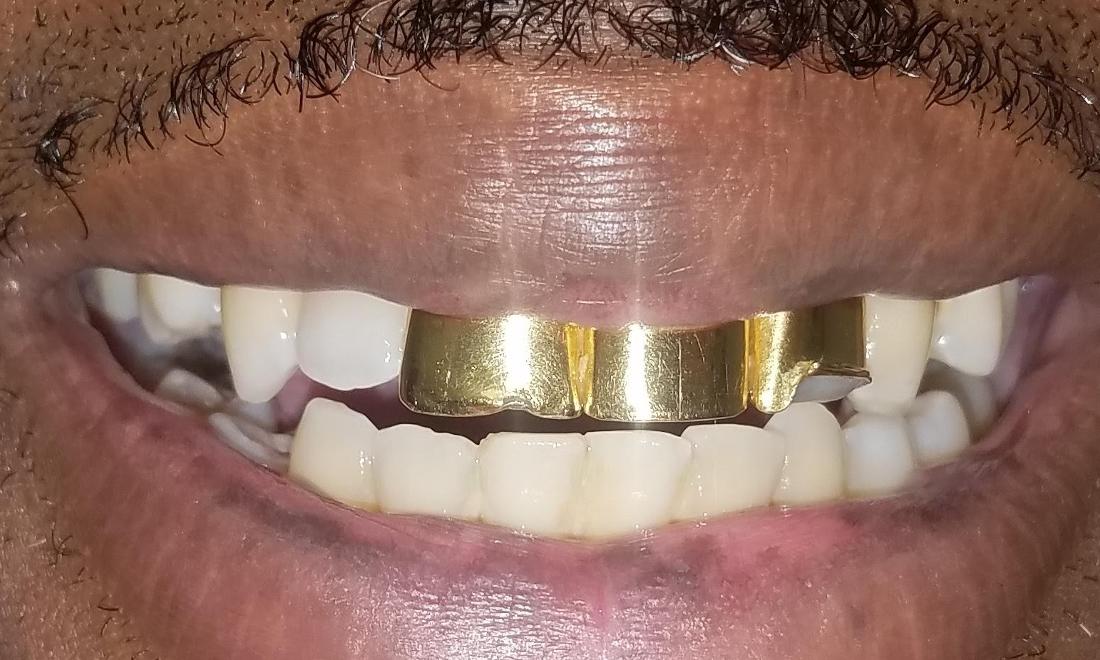 Gold Tooth Gold Tooth