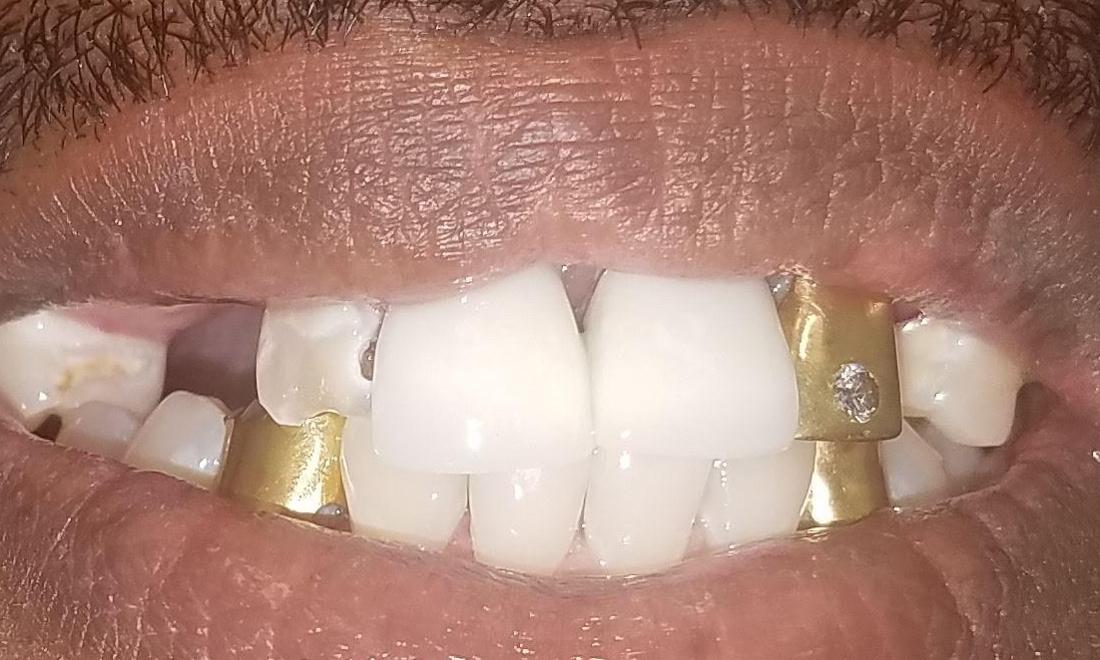 Patient Before Removing Old Golds | NOLA