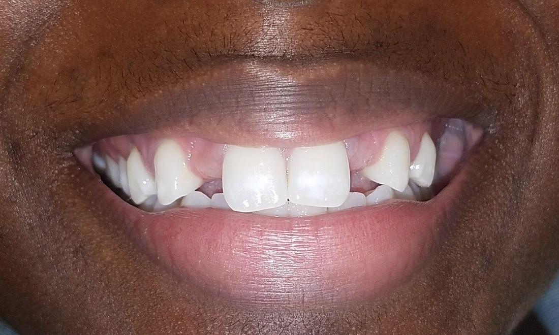 before image of missing incisors
