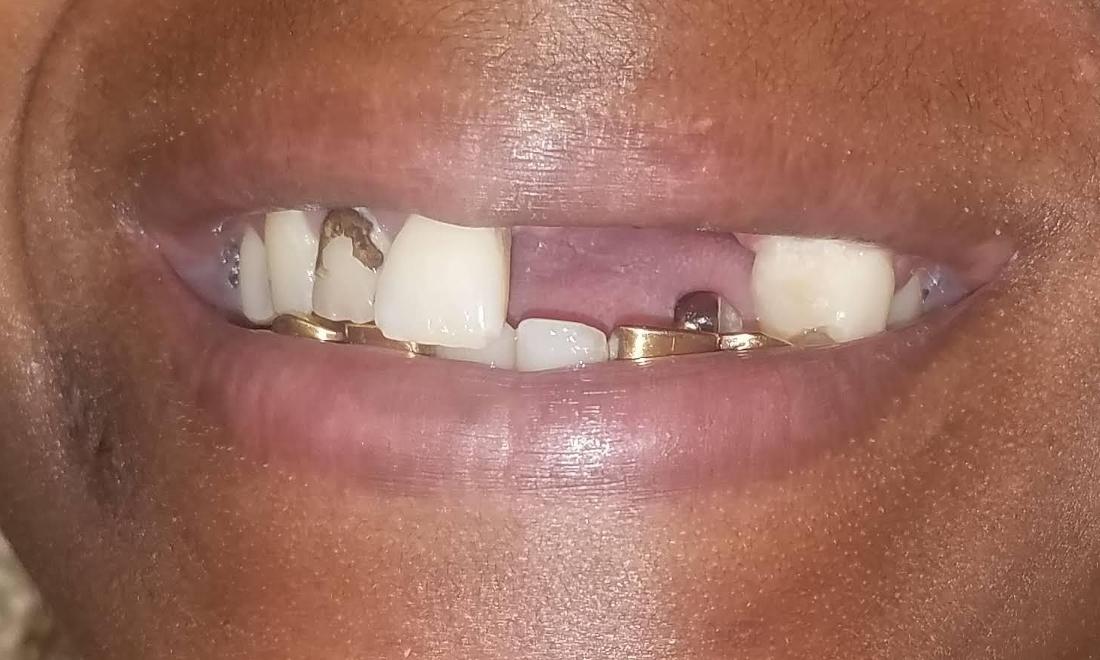 Missing Front Tooth | New Orleans