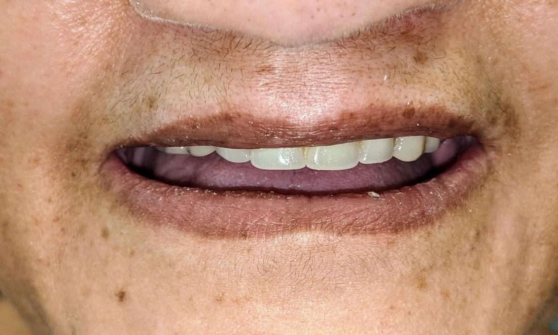 Old Dentures | Gretna LA Dentist