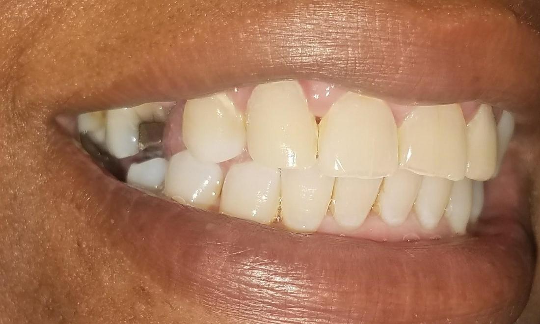 before photo of missing teeth