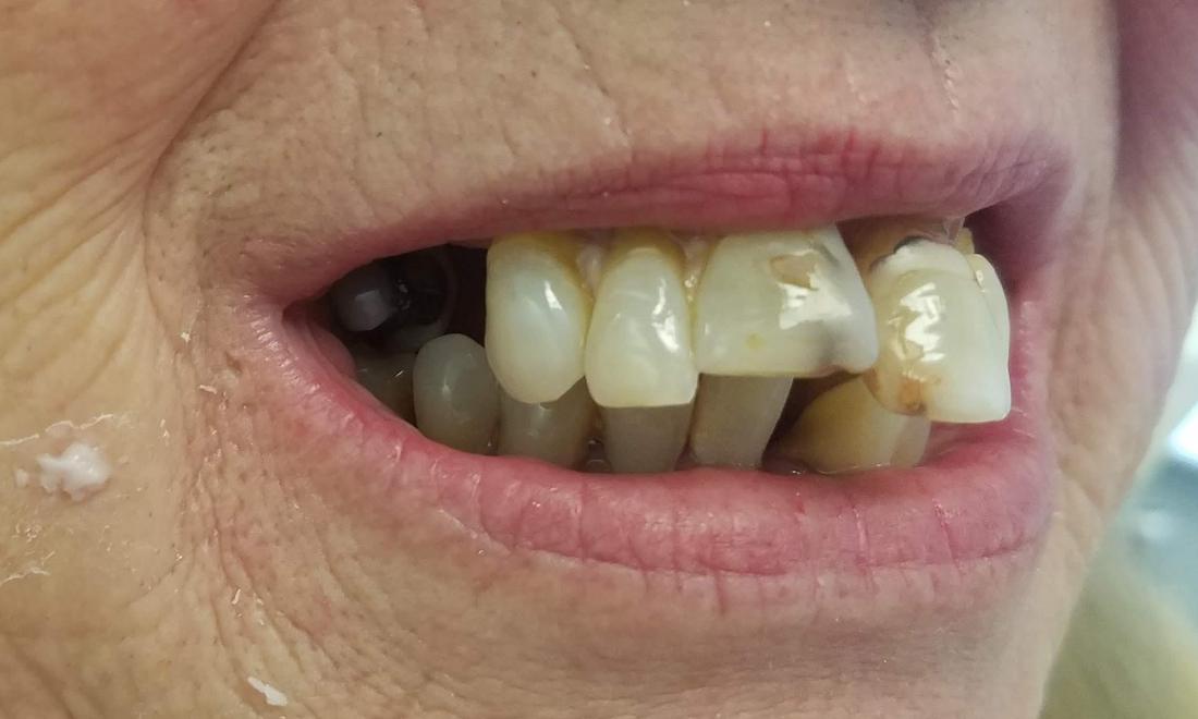 Six Month Smiles Before | Dr. Russell Schafer