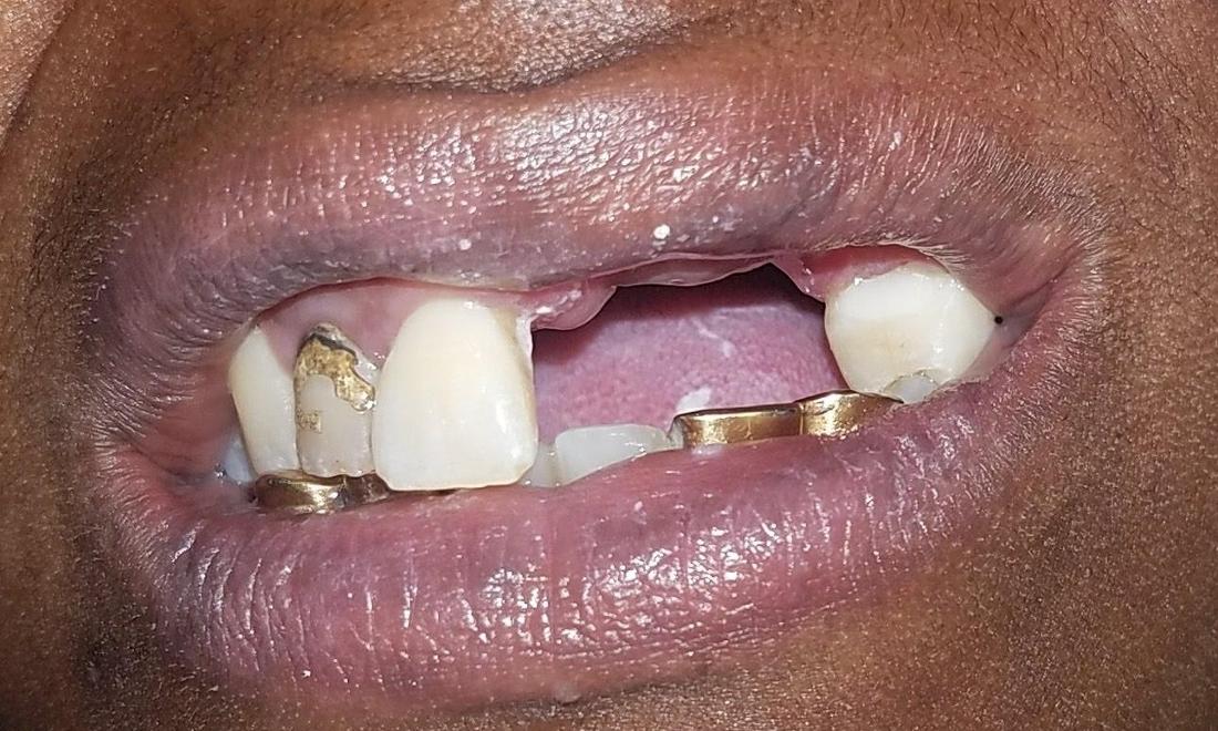 before image of missing front teeth
