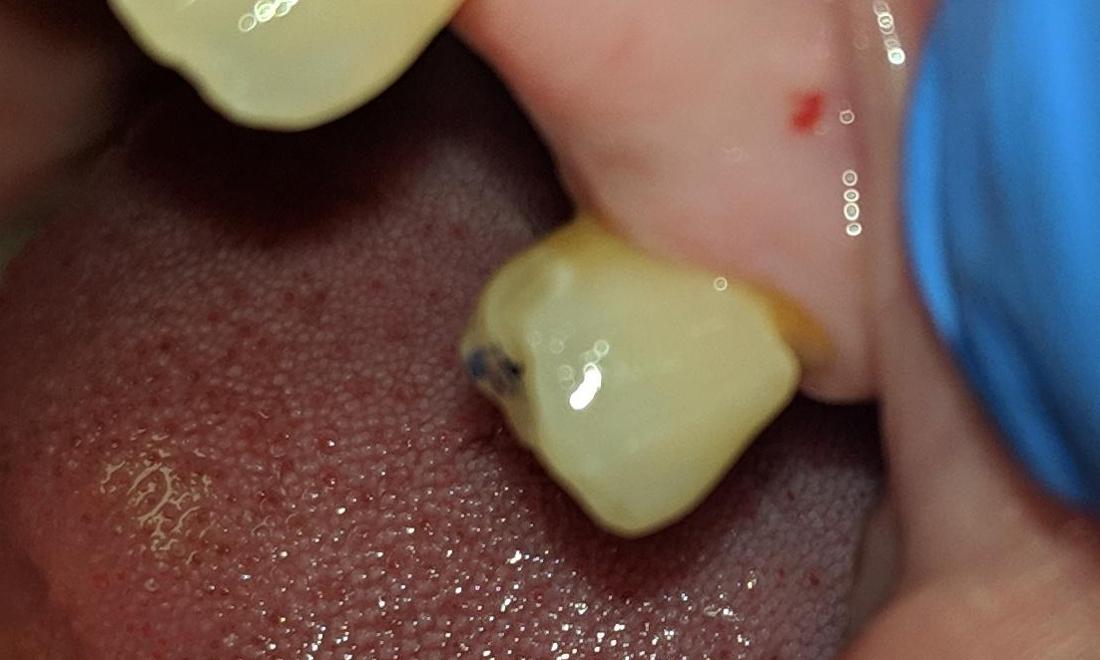 Fractured Tooth | New Orleans Dentist
