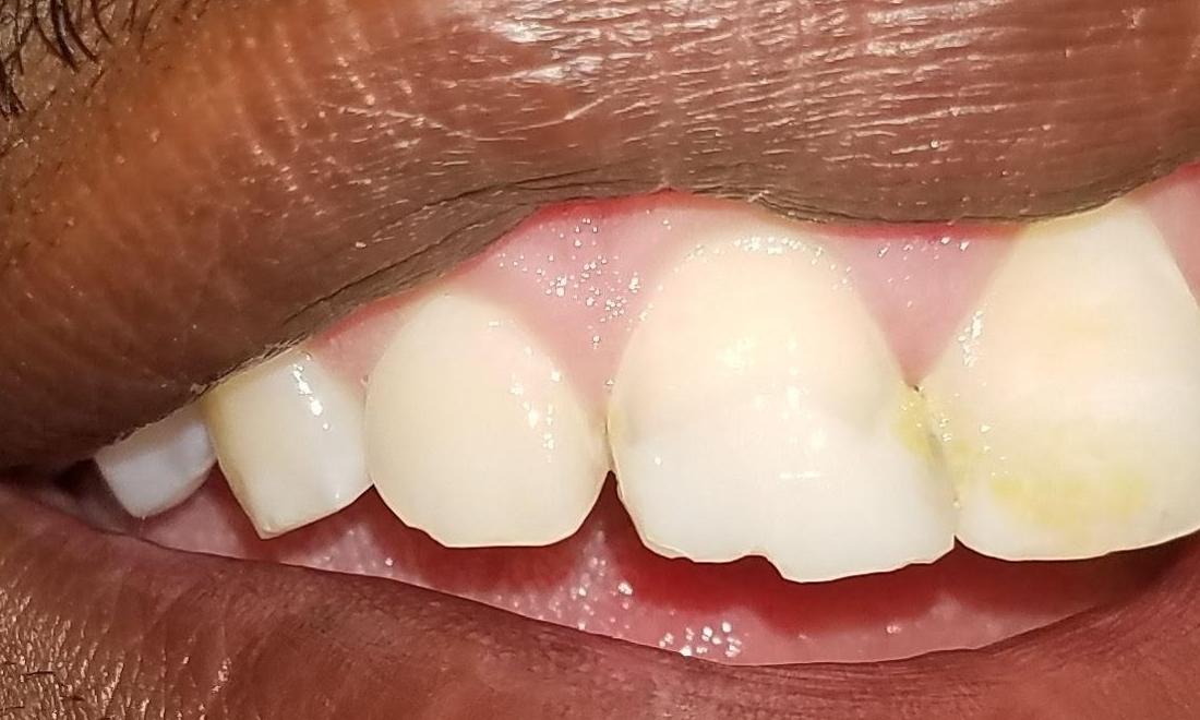 Chipped Front Tooth | Dr. Shafer